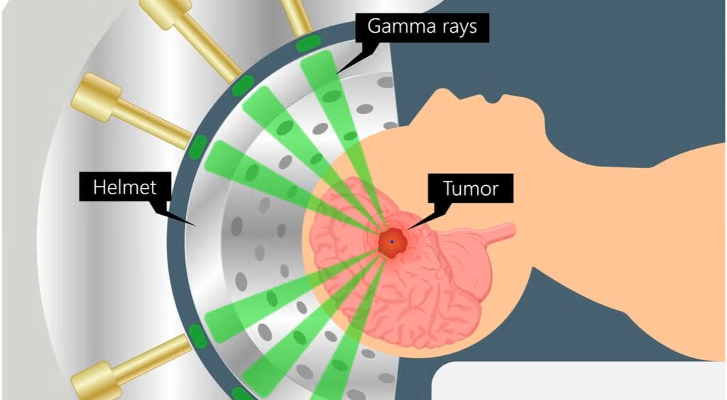 Stereotactic Radiosurgery